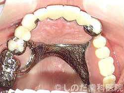 チタン合金の入れ歯2