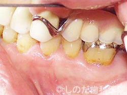 チタン合金の入れ歯4