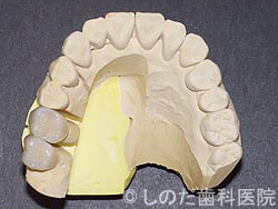 奥歯、大臼歯のハイブリッドセラミック冠1